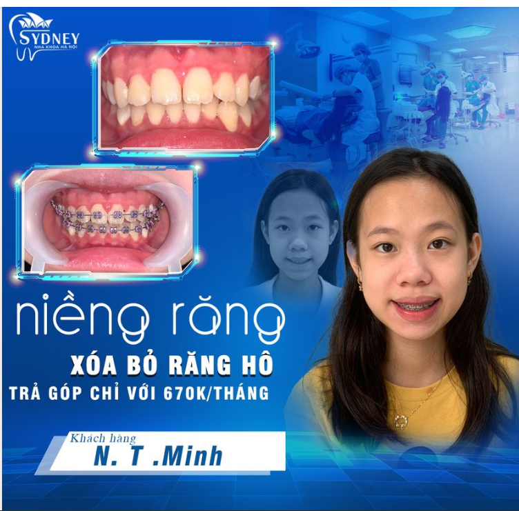 NIỀNG RĂNG HÔ, ĐIỂM TÔ NỤ CƯỜI