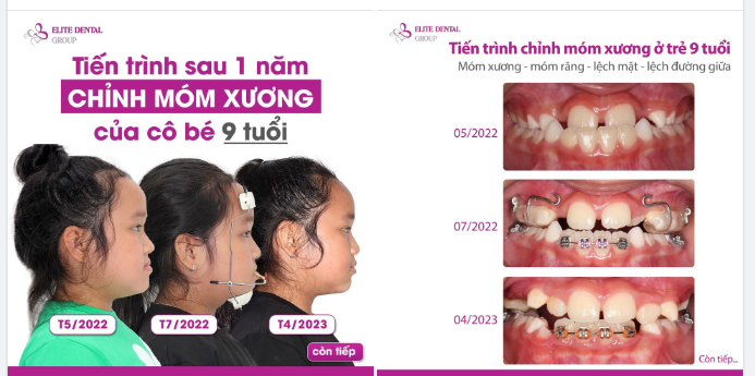 Phụ huynh của bé H.A chia sẻ với Elite Dental.