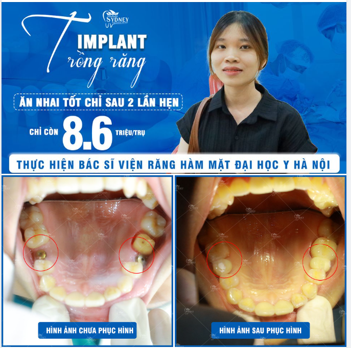 BAO NHIÊU TUỔI THÌ CẤY IMPLANT ĐƯỢC?