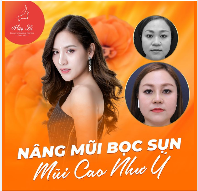 NÂNG MŨI BỌC SỤN - MŨI CAO NHƯ Ý