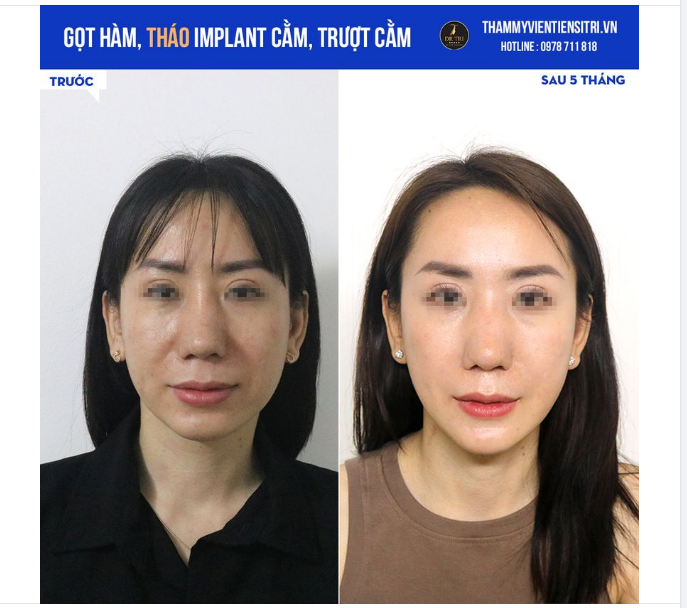 BỎ CÔNG LẶN LỘI ĐƯỜNG XA, CHỊ KHÁCH ĐÃ SỞ HỮU GƯƠNG MẶT TRẺ TRUNG SAU 5 THÁNG