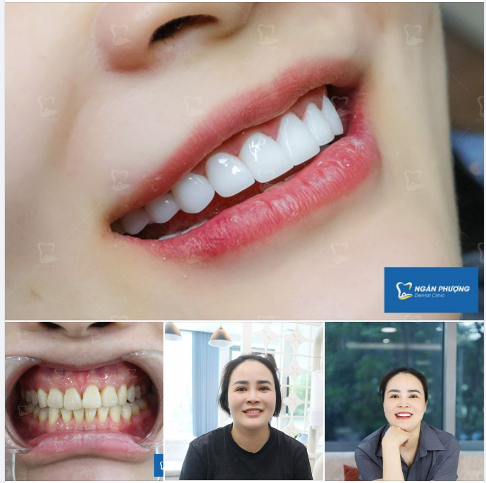 Mất công làm sứ, chọn phom tự nhiên làm gì?
