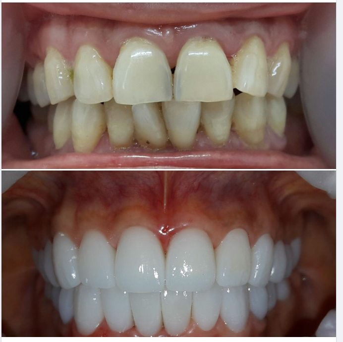 Thay áo mới cho răng tối màu, lệch lạc, dáng răng chưa đẹp.