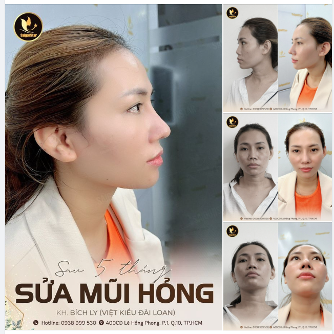 SAU 5 THÁNG SỬA MŨI HỎN.G TẠI BÁC SĨ HOẠT