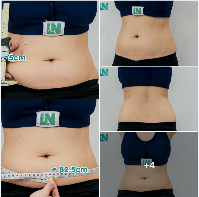 HÚT MỠ TẠO DÁNG THẨM MỸ VÙNG BỤNG CHO NỮ KH 9X, CHƯA SINH EM BÉ – MUỐN ĐẸP HƠN: VÌ THANH XUÂN NGẮN HẠN. TRỰC TIẾP 14H30 HÔM NAY