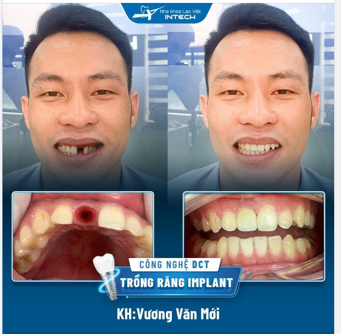 TRỒNG RĂNG CỬA NHỜ CÔNG NGHỆ PHỤC HÌNH DCT - THẨM MỸ HOÀN HẢO NHƯ RĂNG THẬT
