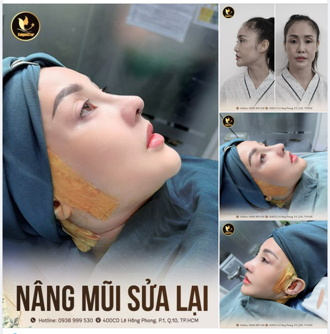 NÂNG MŨI CẤU TRÚC – DÁNG ĐẸP SANG CHẢNH
