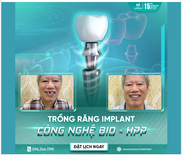 Trồng răng công nghệ Bio HPP thế hệ mới