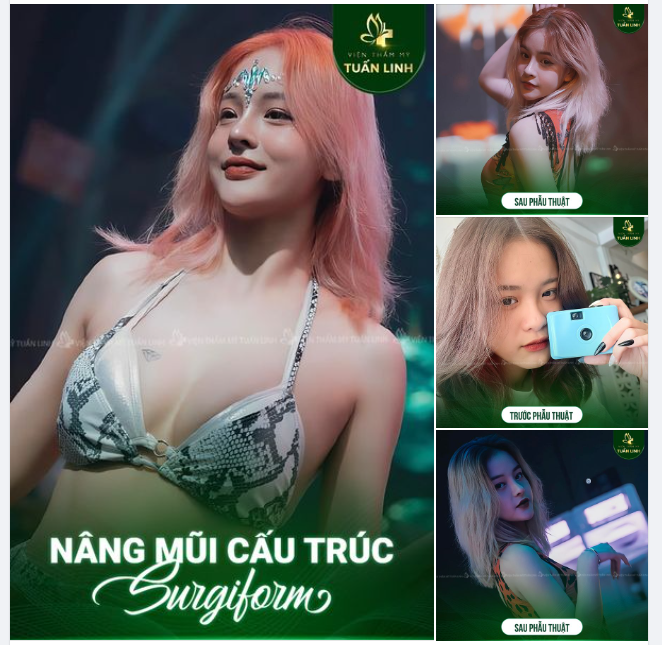 Dáng mũi ưng ý 100% sau 2 tháng nâng tại Tuấn Linh!!
