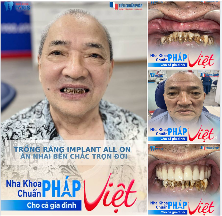MẤT RĂNG TOÀN HÀM LÂU NĂM - CẤY IMPLANT ALL ON ĂN NHAI TRỌN ĐỜI