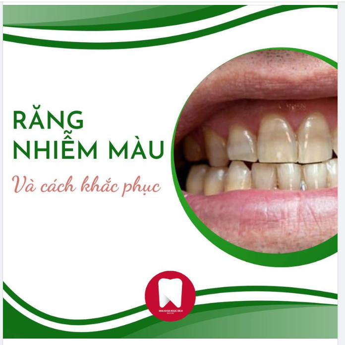 DẤU HIỆU RĂNG NHIỄM MÀU DO KHÁNG SINH & CÁCH KHẮC PHỤC