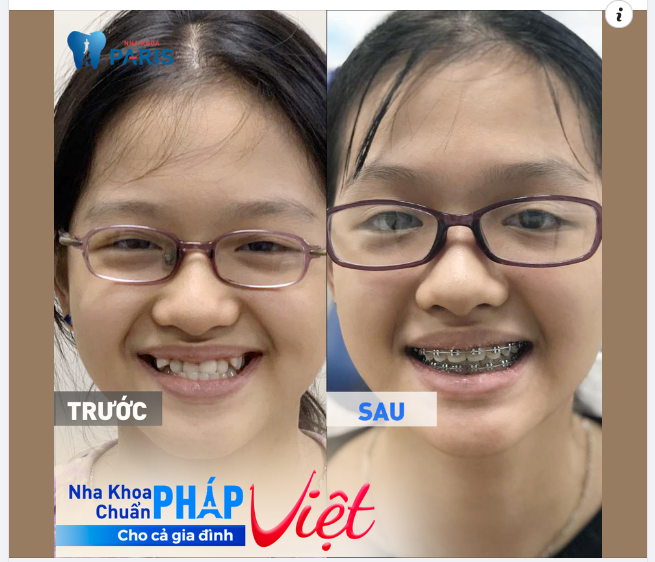 Bé Khánh Huyền, 14 tuổi thay đổi hàm răng từ khấp khểnh, lệch lạc sang đều đẹp tại nha khoa Paris trong suốt một năm qua.