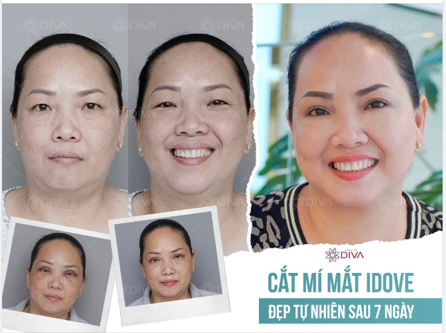 KẾT QUẢ CẮT MÍ MẮT - ĐẸP TỰ NHIÊN SAU 7 NGÀY