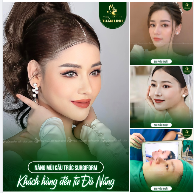 Khách hàng đến từ Đà Nẵng nâng mũi cấu trúc Surgiform - Dáng mũi sau 3 năm thực hiện.