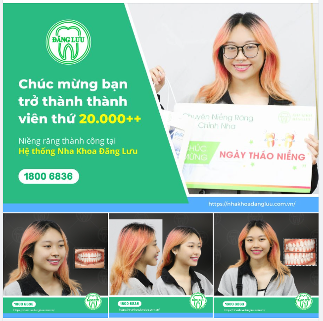 CHUYÊN MỤC THÁO NIỀNG Tạm biệt răng thưa, cắn ngược
