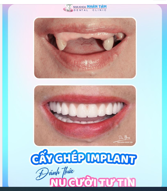 Mất răng.. mất tự tin … mất đi sự phấn khởi từ những điều đơn giản nhất!