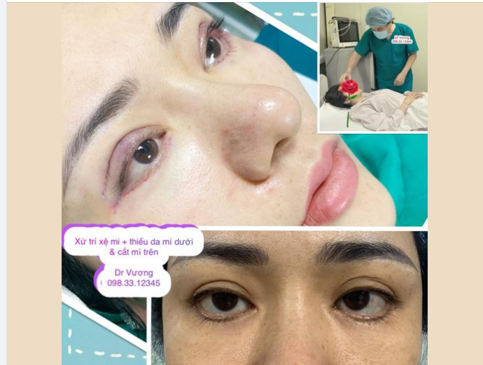 Dr Vương xử trí võng-xệ mi + sẹo xấu + thiếu da mí dưới cho bạn gái tử Biên Hoà, Đồng Nai (do cắt mí dưới ở spa …)