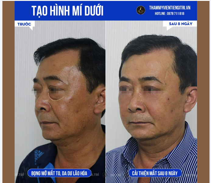 QUÊN ĐI BỌNG MỠ NHỜTạo hình mí dưới
