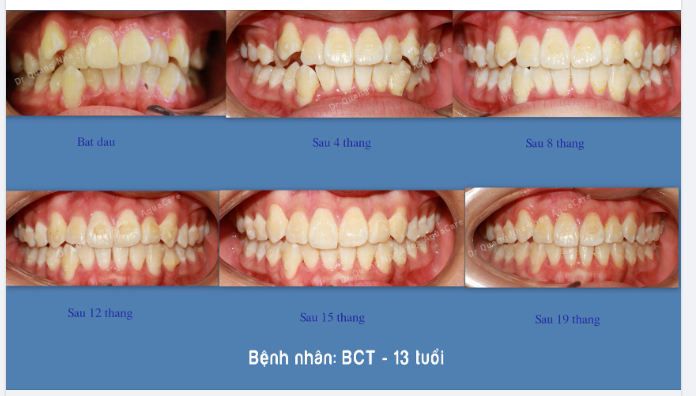 LÝ DO CẦN PHẢI CAN THIỆP NIỀNG RĂNG SỚM CHO TRẺ