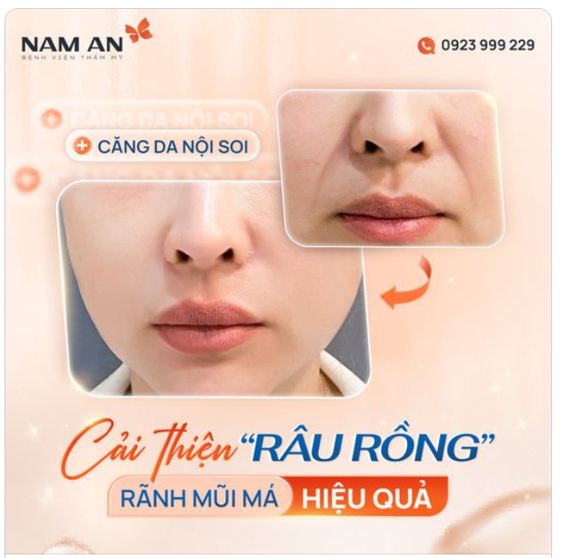 CẢI THIỆN "RÂU RỒNG" RÃNH MŨI MÁ SIÊU HIỆU QUẢ ƯU ĐÃI 35% CĂNG DA NỘI SOI