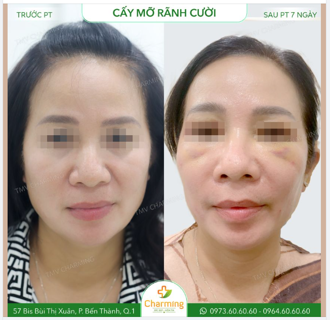 Rãnh cười sau khi cấy mỡ có thể ngay lập tức lấp đi chiếc râu rồng sâu hoắm. Cơ mà cả nhà có thể thấy được vết sưng trên khuôn mặt bạn, nhưng đó không phải là sưng do cấy mỡ đâu nha