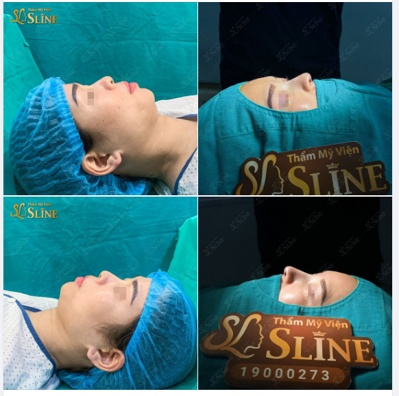 Thay đổi diện mạo với NÂNG MŨI CẤU TRÚC