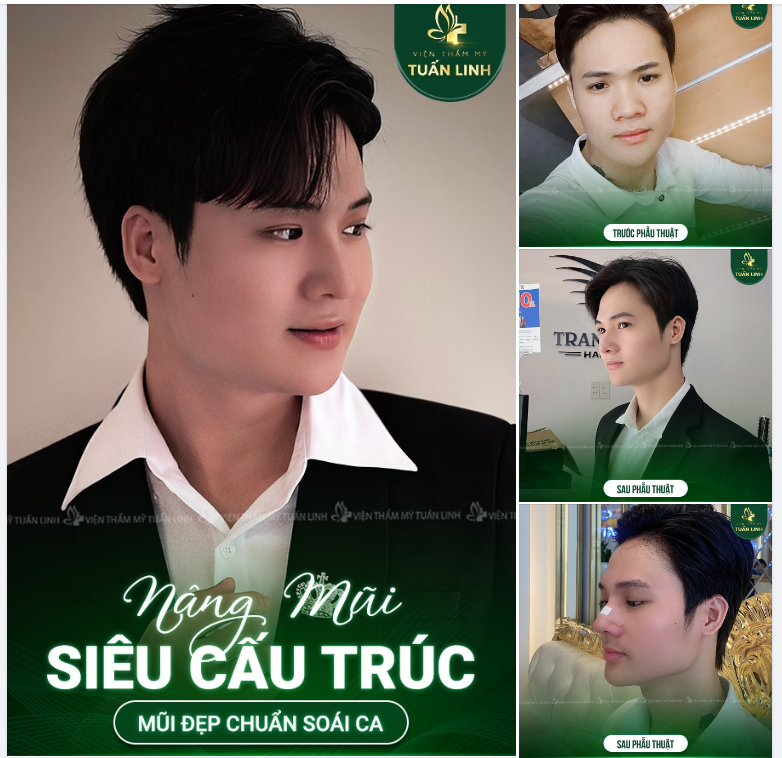 NÂNG MŨI SIÊU CẤU TRÚC - MŨI BỀN ĐẸP CHUẨN SOÁI CA