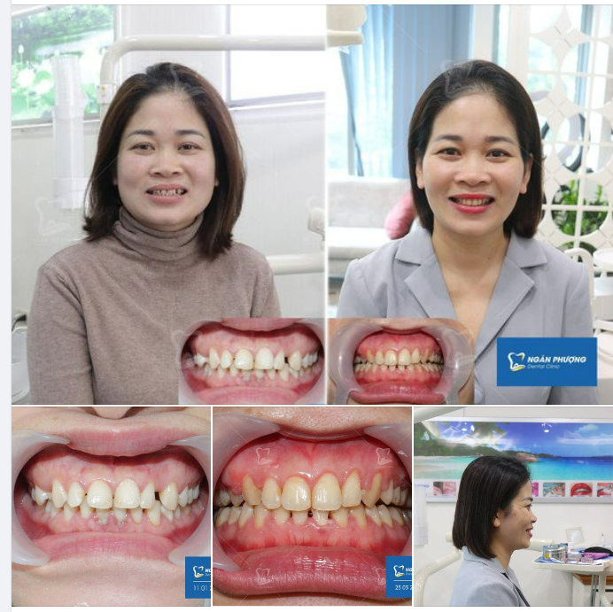Niềng răng khỏe đẹp chưa bao giờ là quá muộn