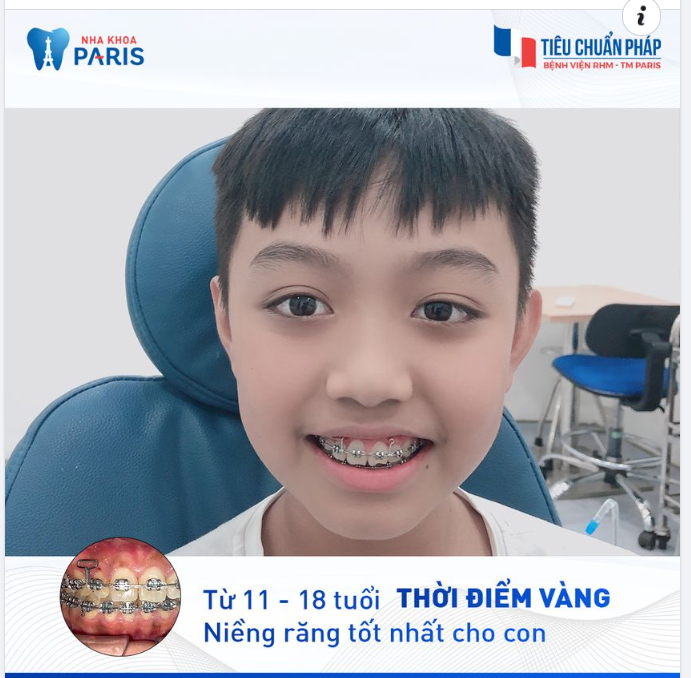 BỐ MẸ ĐỪNG BỎ LỠ GIAI ĐOẠN VÀNG NIỀNG RĂNG CHO CON