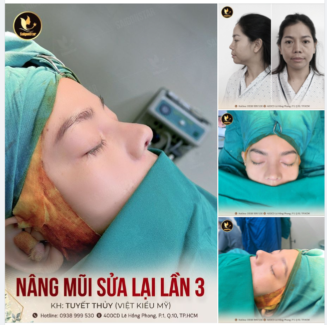 HỒI KẾT LẦN THỨ 3 NÂNG MŨI