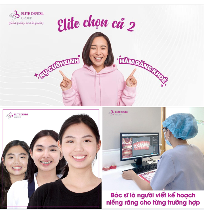 CHỈNH NHA VÌ NỤ CƯỜI ĐẸP HAY HÀM RĂNG KHỎE? ELITE CHỌN CẢ HAI!