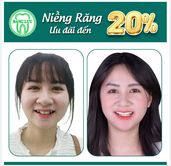 Nụ Cười Tươi Mới, Dẫn Lối Thành Công - Ưu Đãi Đến 20% Chi Chí Niềng Răng Dịp Hè Này!