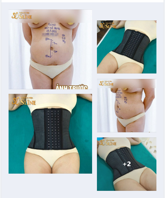 HÚT MỠ BỤNG - TRỌN GÓI 39,9TR