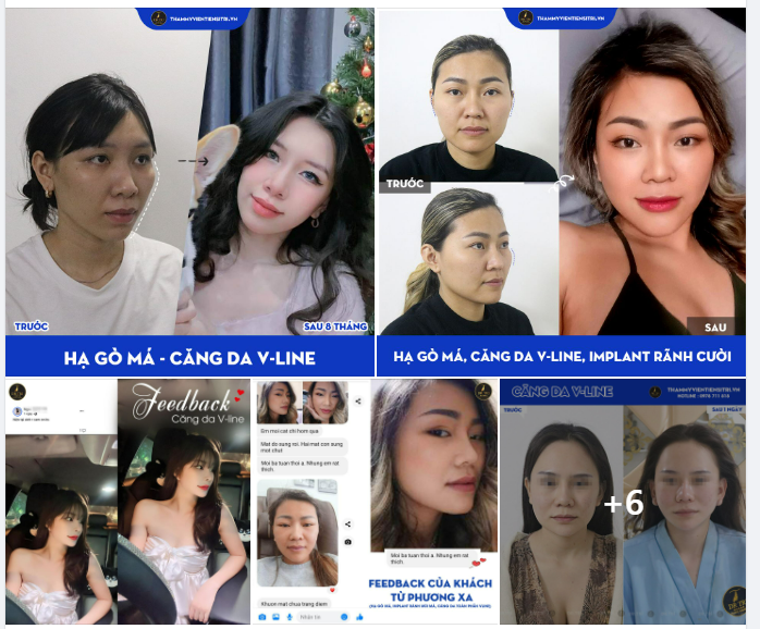 DỊCH VỤ VÀNG CĂNG DA V-LINE