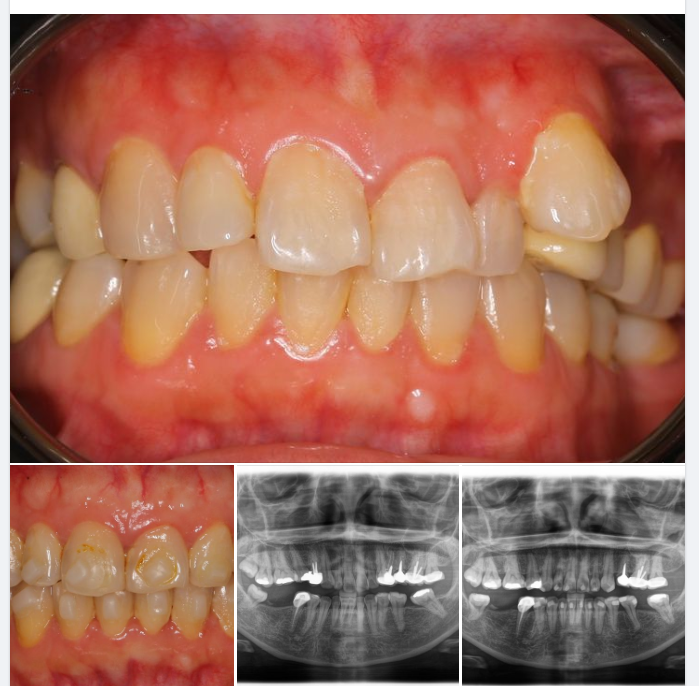 Một ca niềng Invisalign tại chi nhánh 61 Nguyễn Cơ Thạch, Sala, Q.2!