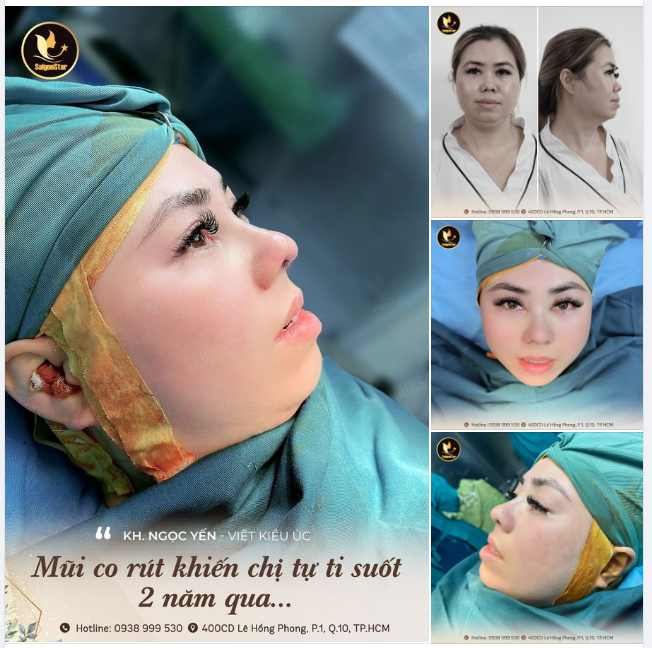 “Mũi co rút khiến chị tự ti suốt 2 năm qua” – Chị Ngọc Yến (Việt kiều Úc)