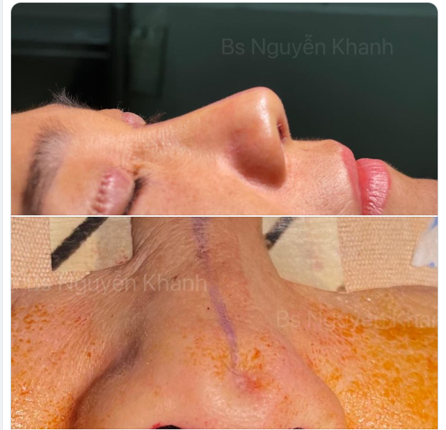Chị làm mũi hơn 15 năm, đặt sóng giả đơn giản thôi. Nay lộ chóp, lộ sóng và sóng thô dáng x.ấu.