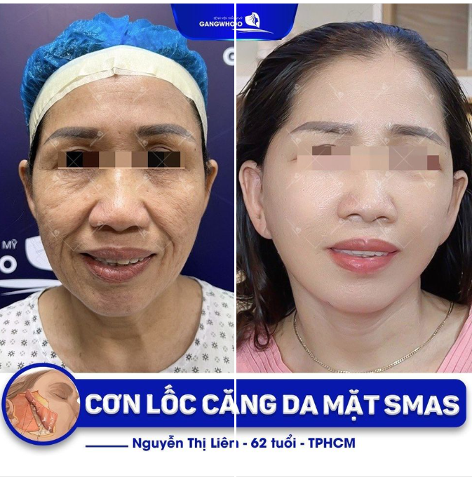 CƠN LỐC CĂNG DA MẶT SMAS