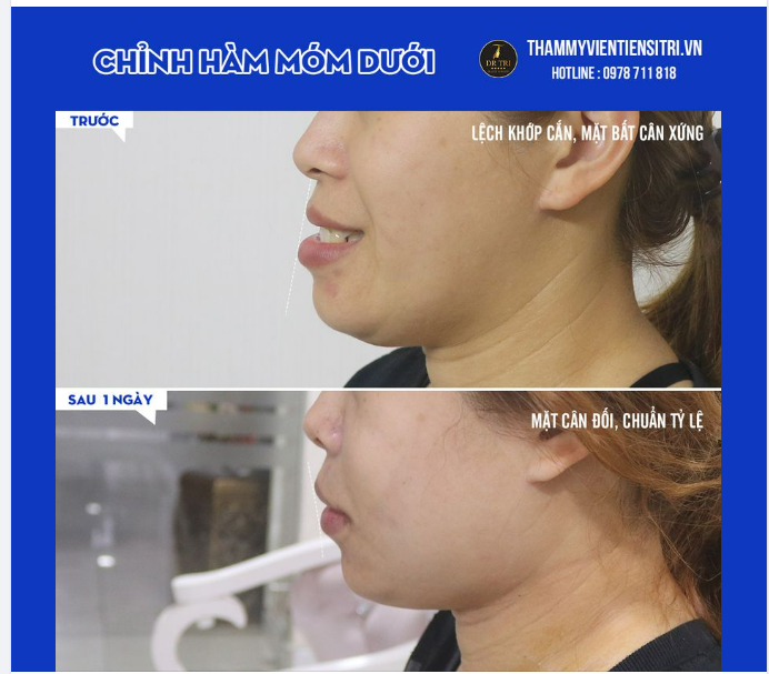 LIỆU CÓ SỰ KHÁC BIỆT NÀO SAU 1 NGÀY PHẪU THUẬT CHỈNH MÓM