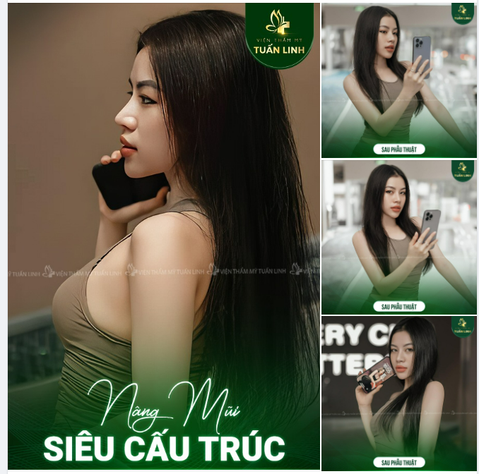 Chị em nào mê dáng mũi Cao Tây nhưng vẫn Tự Nhiên thì Nâng Mũi Siêu Cấu Trúc dáng mũi Angel line nhà Tuấn Linh là hợp lý đó ạ.