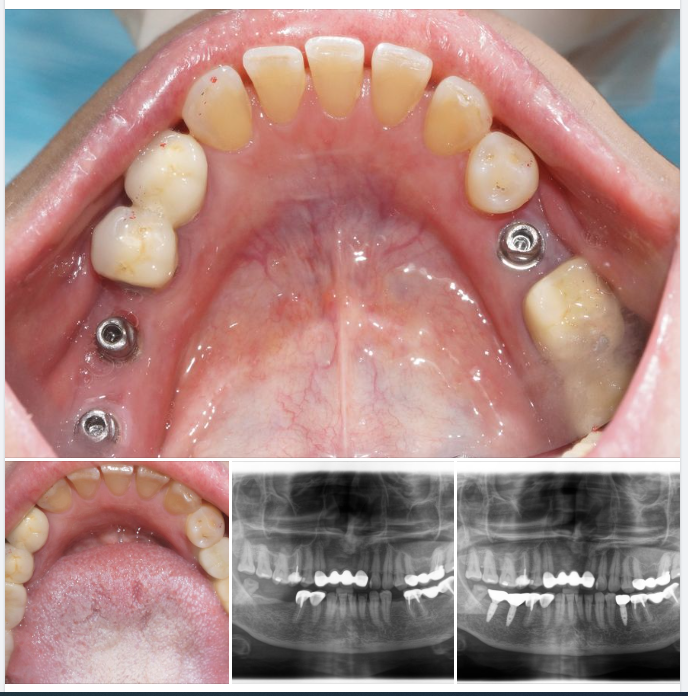 PHỤC HÌNH RĂNG SỨ TRÊN IMPLANT