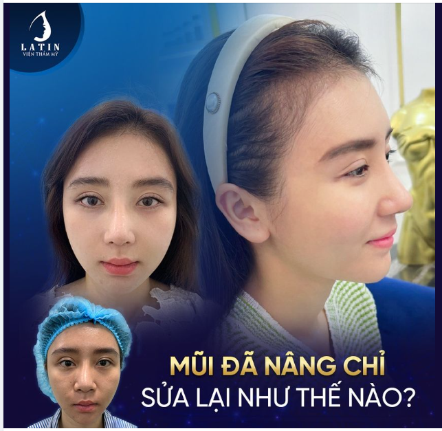 Mũi đã nâng chỉ, sửa lại như thế nào