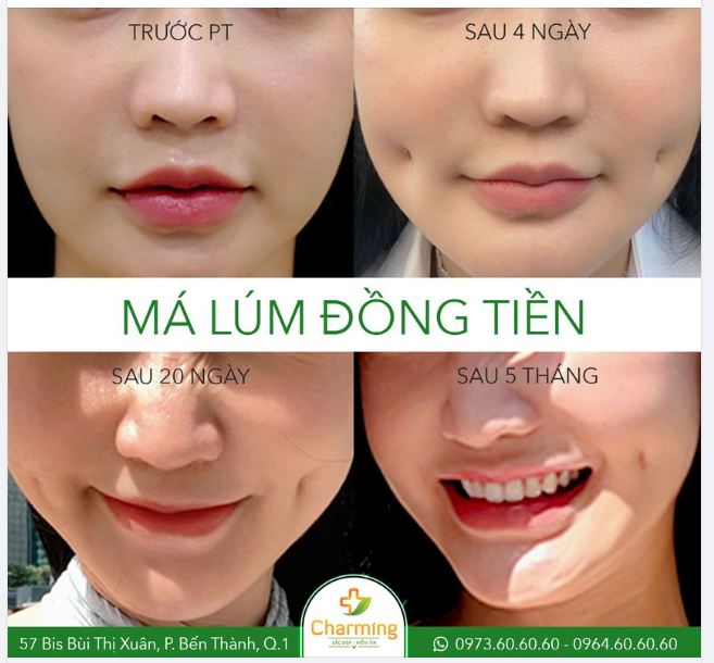 Lâu lâu Charming nhá hàng hình ảnh làm má lúm đồng tiền hổng thôi mọi người quên tại Charming còn có chiếc phẫu thuật xinh duyên muốn xỉu này