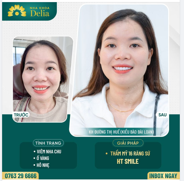 Thẩm mỹ răng sứ - kiến tạo nụ cười khoẻ đẹp cho kiều bào Đài Loan