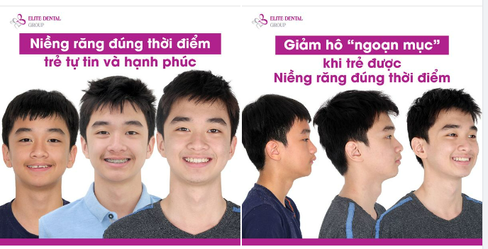 Niềng răng hô, cắn chìa từ sớm - thay đổi nhỏ, hoàn thiện khí chất “soái ca”