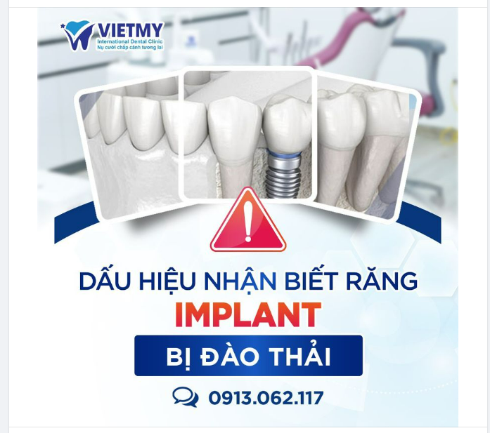 "SOS!! CẢNH GIÁC VỚI TÌNH TRẠNG IMPLANT BỊ ĐÀO THẢI NÊU CÓ 3 DẤU HIỆU NÀY...