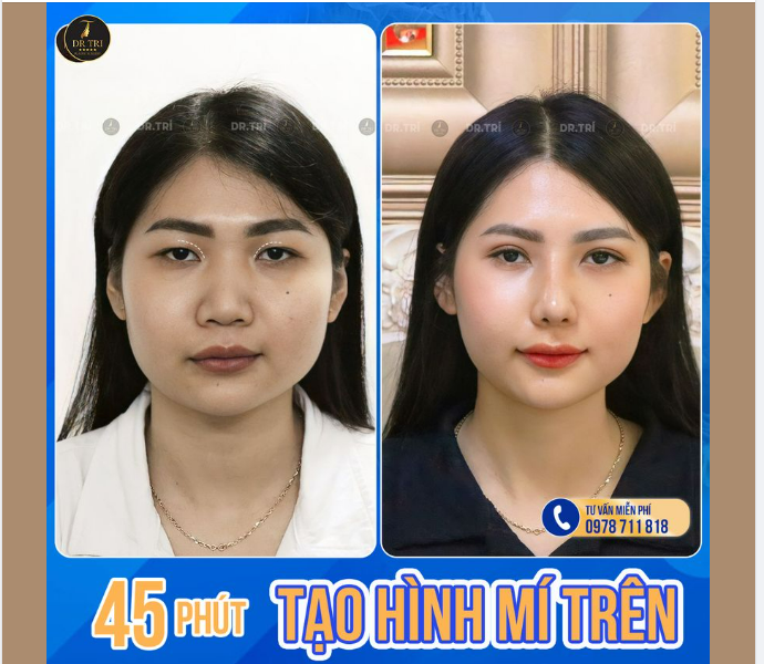 THAY ĐỔI NHỎ - KHÁC BIỆT LỚN NHỜ Tạo hình mí