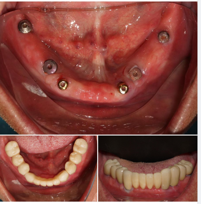 Trường hợp đặt Implant phục hình răng của bác sĩ Tú, chi nhánh 149 Tôn Dật Tiên, Q7