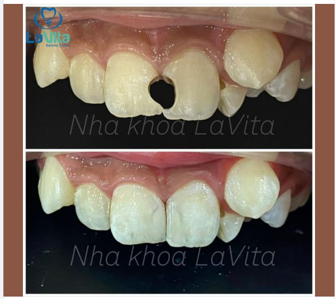 Với các trường hợp răng cửa bị sâu, vỡ thì giải pháp tốt nhất được bác sĩ chỉ định là làm phục hình răng sứ.