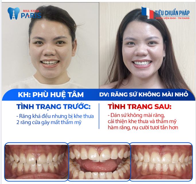 XU HƯỚNG THẨM MỸ RĂNG SỨ TỐI ƯU - KHÔNG MÀI NHỎ